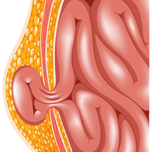 cirugia-de-hernia-en-tijuana-bc-precio-tratamiento
